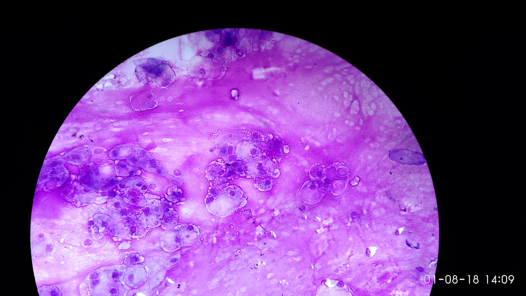 Sacral Mass Mimicking Sarcoma Radiologically